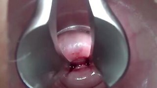 Extreme cervix playing with insertion metal chain in uterus